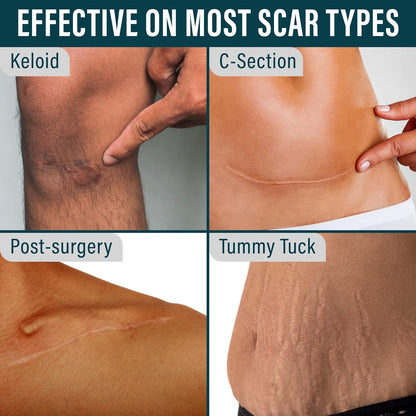 ScarEase Pro Silicone Tape