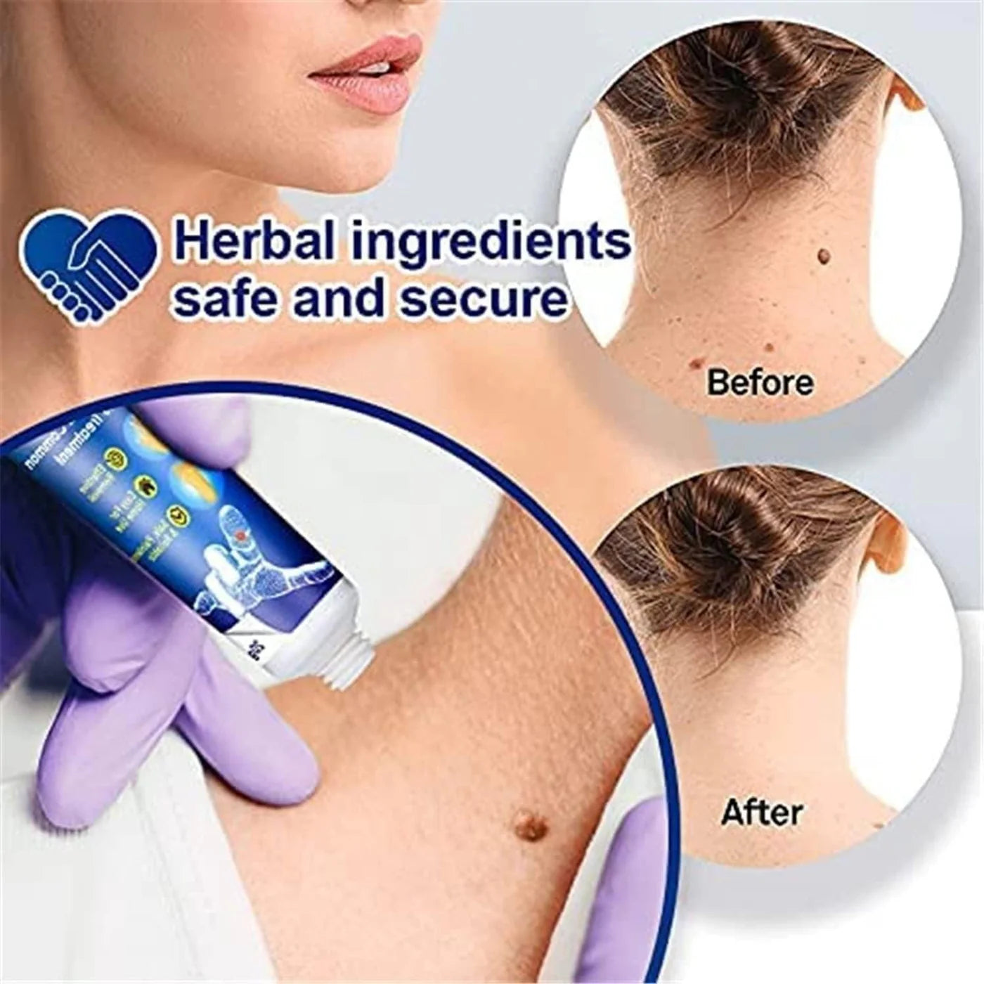 Wart Remover Instant Blemish Removal Cream (Buy 1 Get 1 Free)